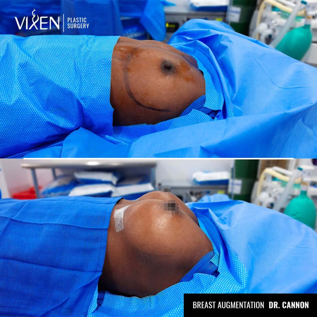 before and after side view of breast augmentation
