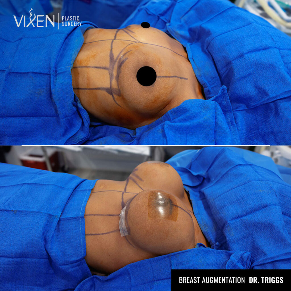 before and after breast augmentation with implants