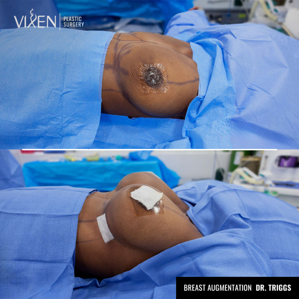 before and after comparison of breast implant augmentation