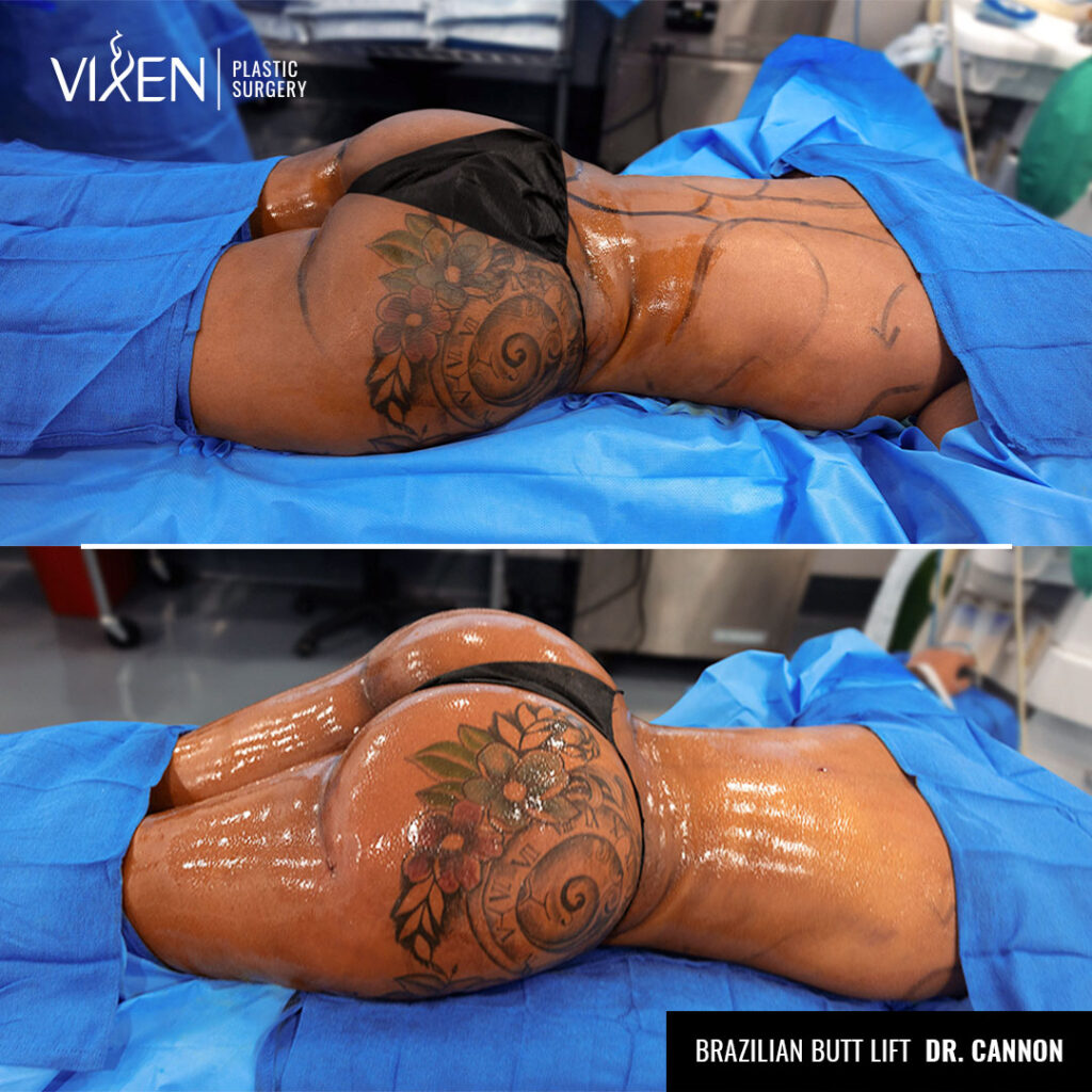 before and after comparison of butt augmentation