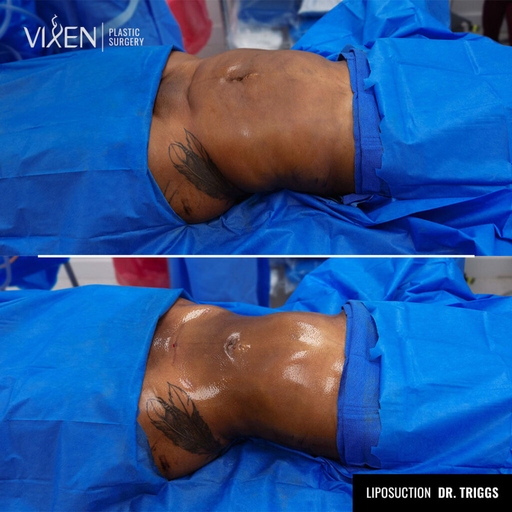 before and after abdomen liposuction comparison