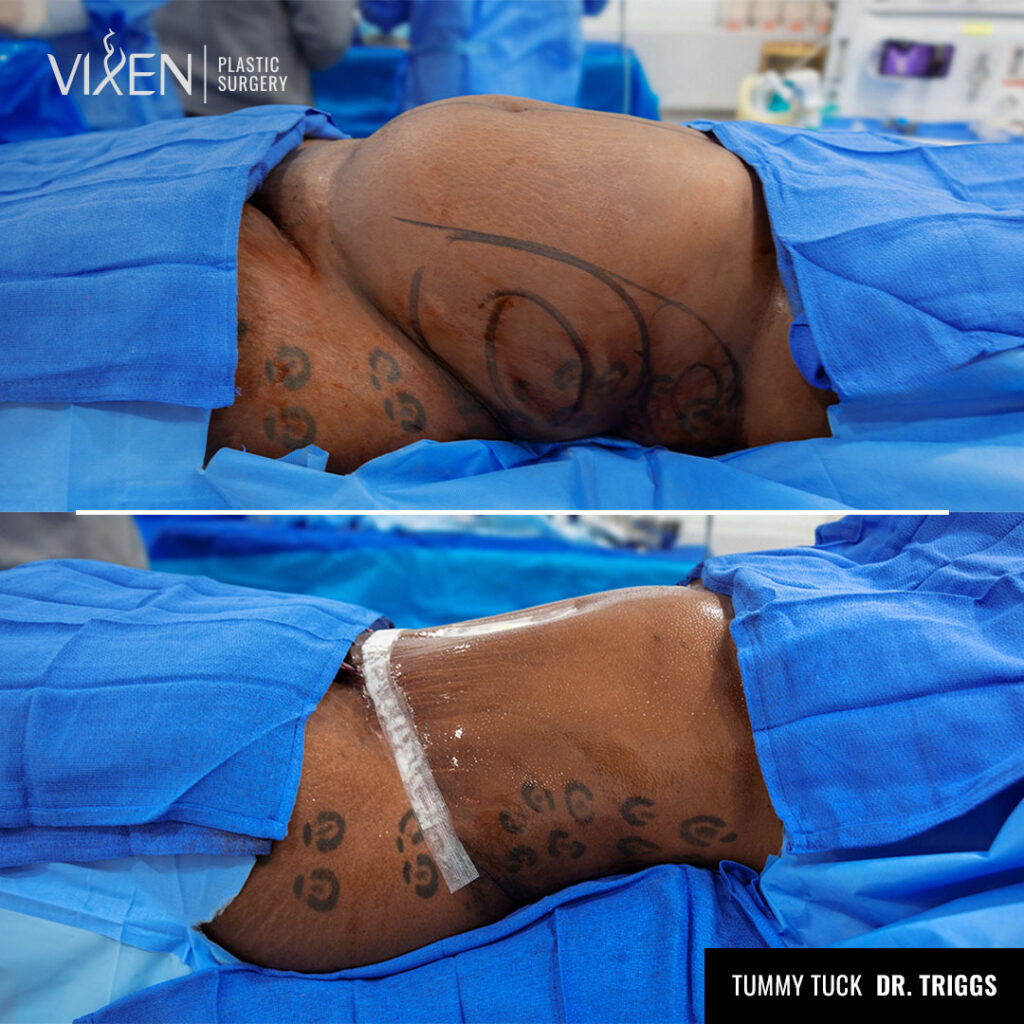 before and after side view of tummy tuck procedure