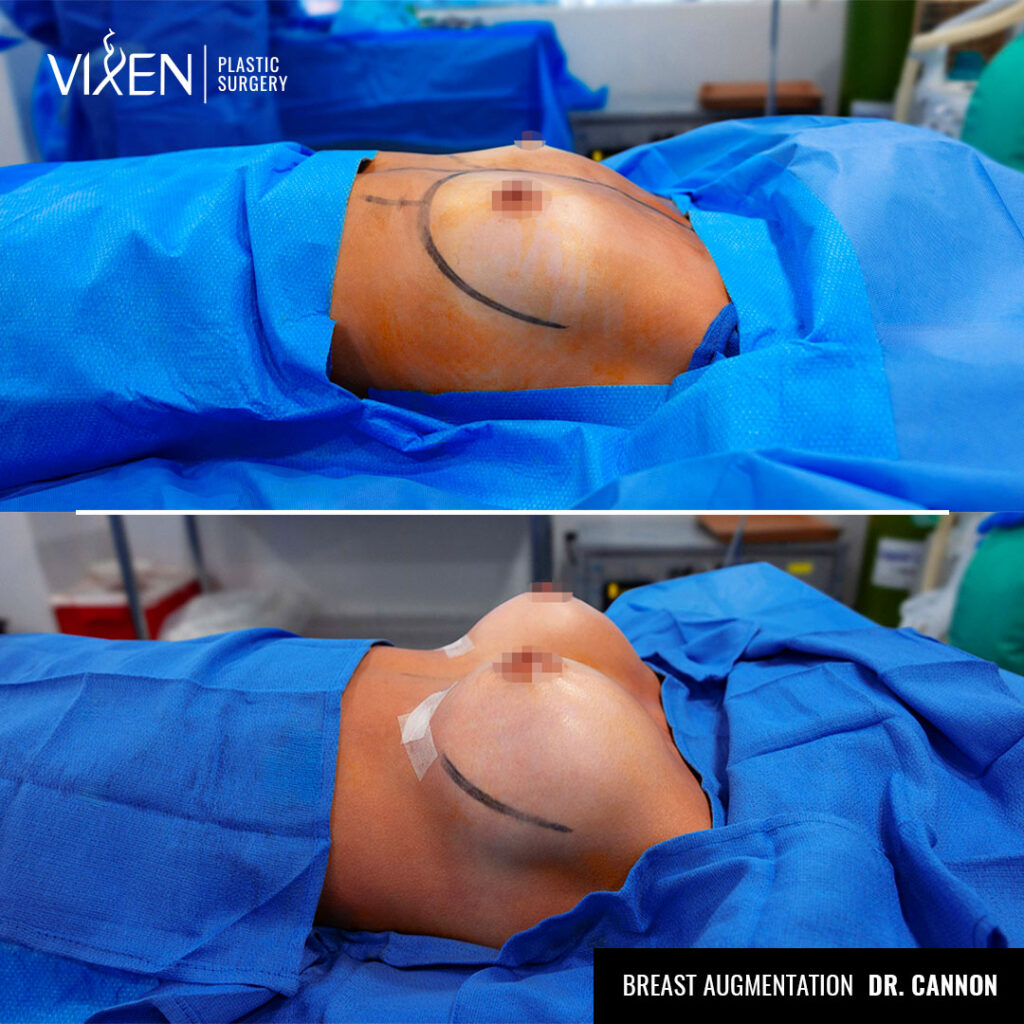 before and after side view of breast augmentation