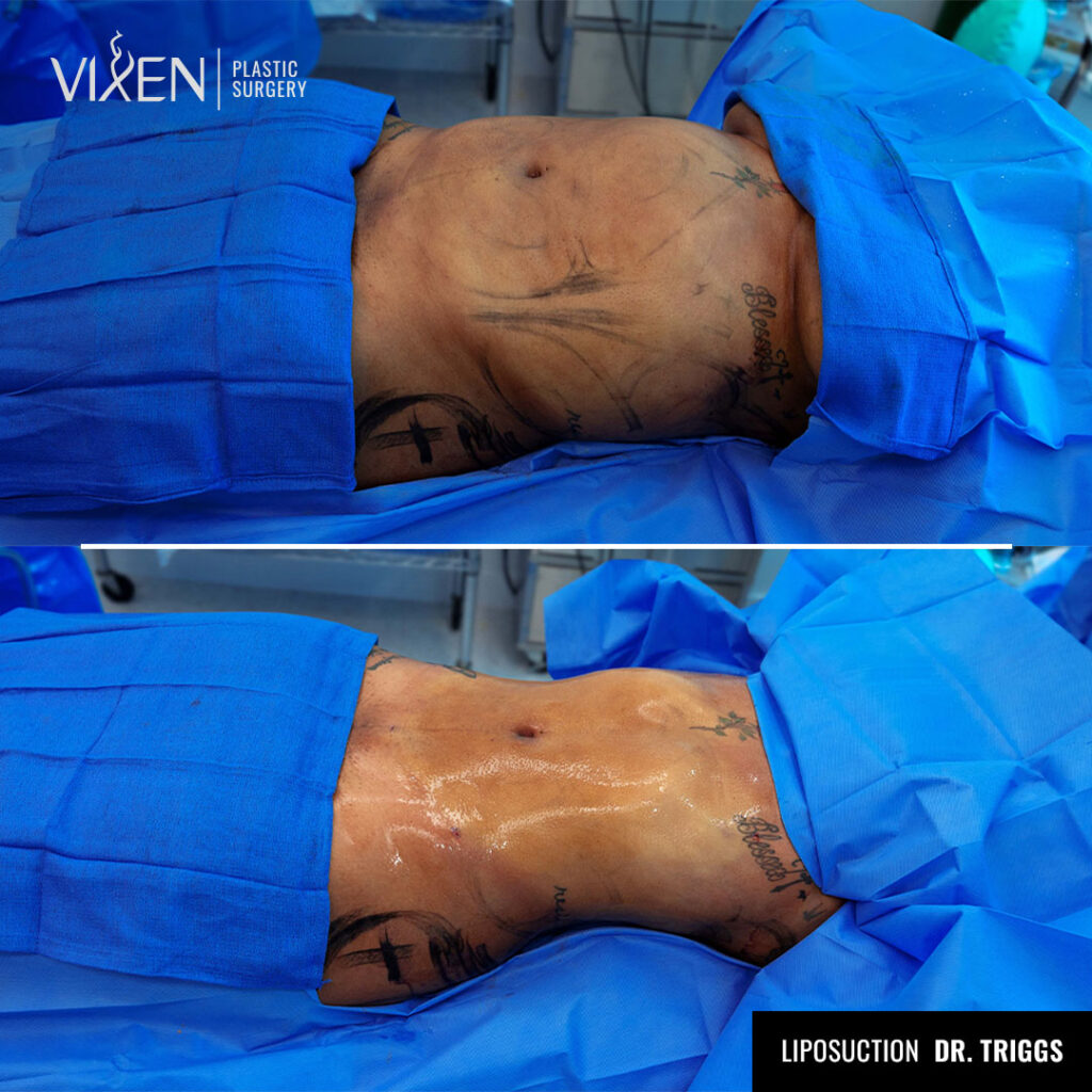 side view comparison of before and after liposuction procedure in the abdomen