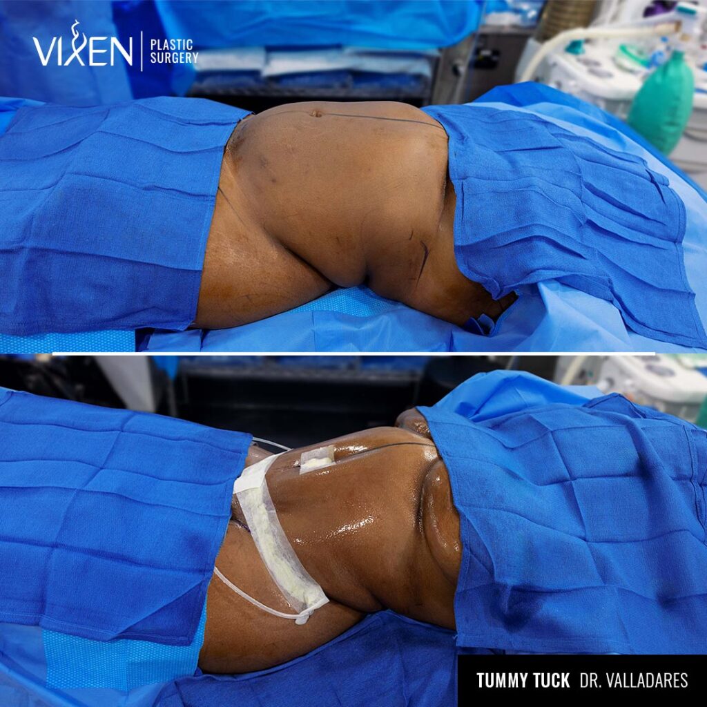 tummy tuck before and after comparison