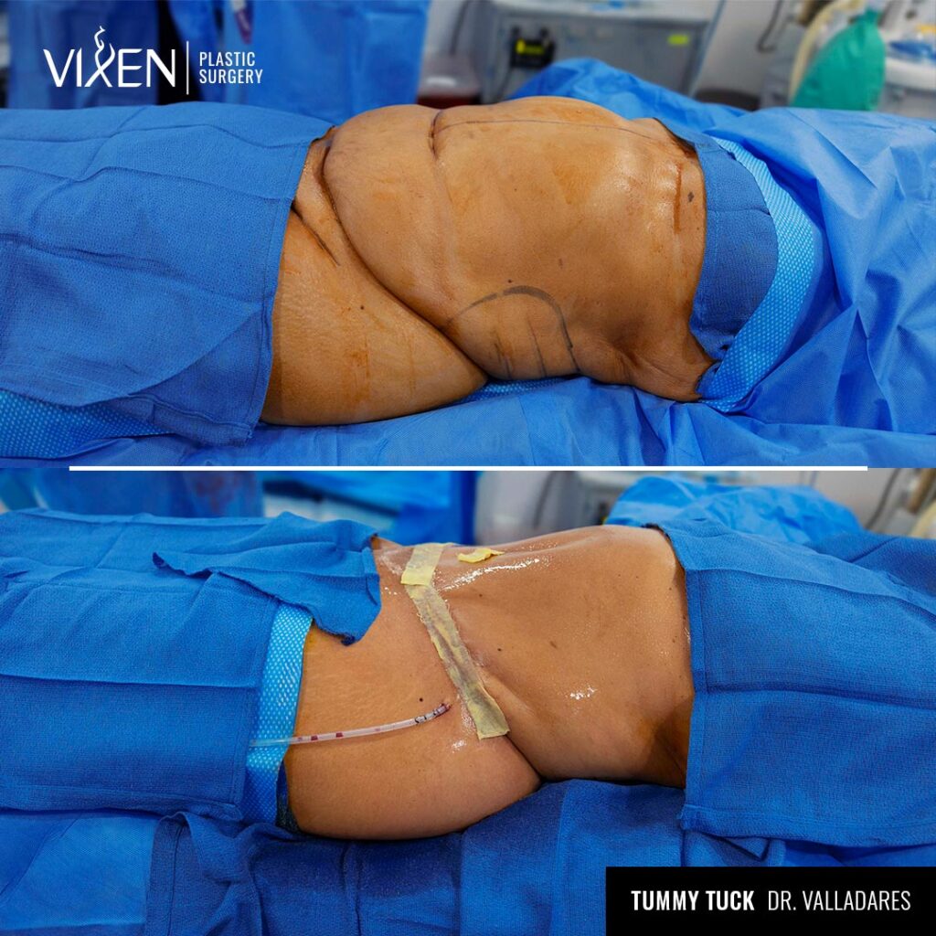 side view of tummy tuck before and after