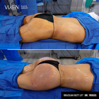 brazilian butt lift results before and after