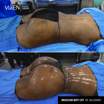 brazilian butt lift augmentation before and after
