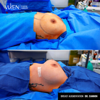 before and after comparison of breast augmentation with implants