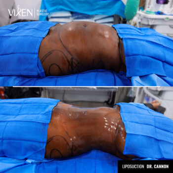 before and after comparison of abdomen liposuction