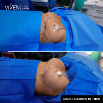 before and after comparison of breast augmentation surgery