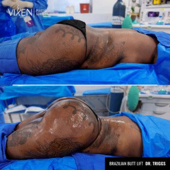 before and after comparison of brazilian butt lift surgery