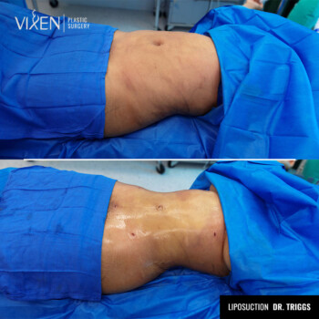 before and after comparison of stomach liposuction side view