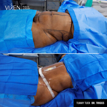 before and after comparison picture of tummy tuck patient