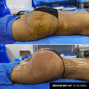 brazilian butt lift before and after side view
