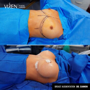 side view before and after comparison of breast augmentation