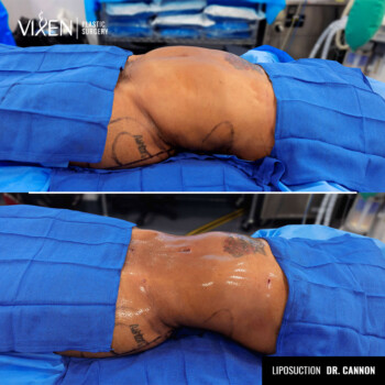 stomach liposuction before and after