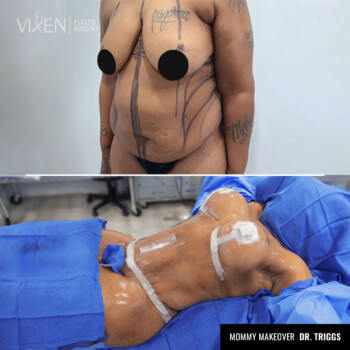 before and after comparison of mommy makeover abdomen and breasts transformation