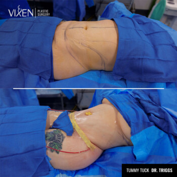 side view of before and after a tummy tuck surgery