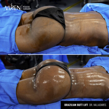 bbl before and after side top view