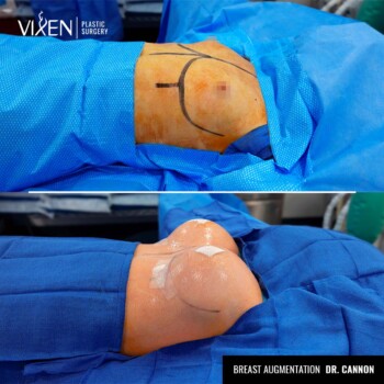 before and after comparison of breast augmentation