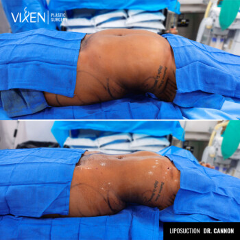 side view before and after of stomach liposuction
