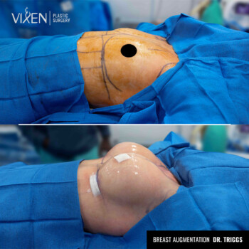 before and after comparison of breast augmentation