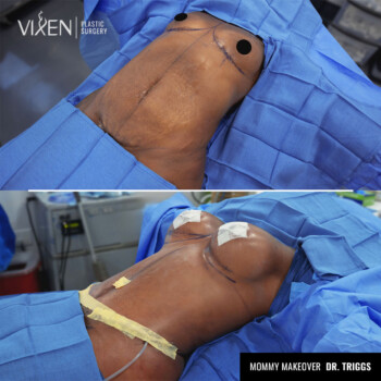 before and after comparison of mommy makeover on abdomen and breasts