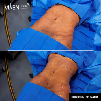 top view before and after of stomach liposuction
