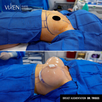 before and after side view of breast augmentation