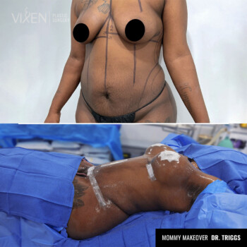 before and after comparison of mommy makeover procedure