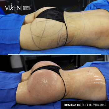 bbl before and after results