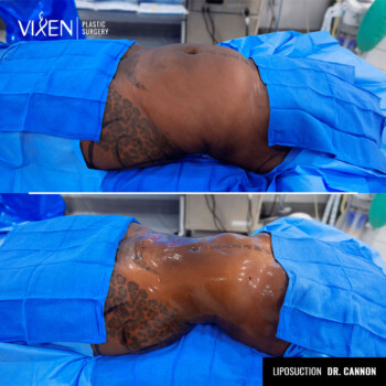 before and after side view of 360 liposuction surgery
