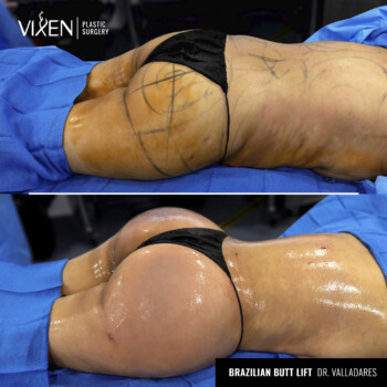 brazilian butt lift before and after results