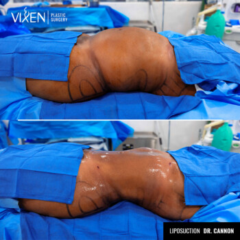 before and after side view of 360 liposuction