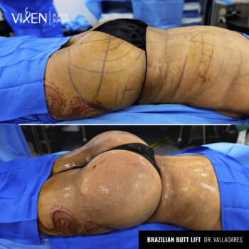 brazilian butt lift before and after results