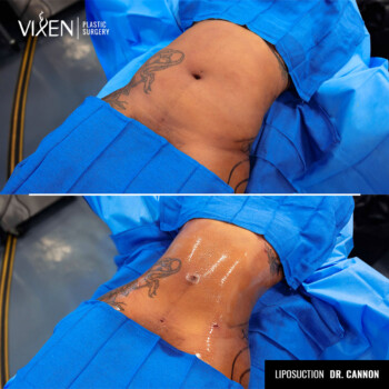 top view of before and after liposuction procedure