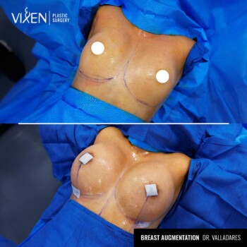 top view before and after comparison of breast augmentation