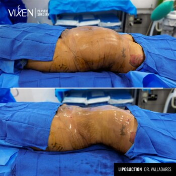 before and after comparison of 360 liposuction