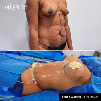 before and after comparison of mommy makeover combo surgery