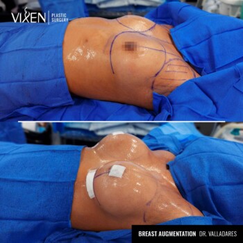 before and after comparison of teardrop breast augmentation