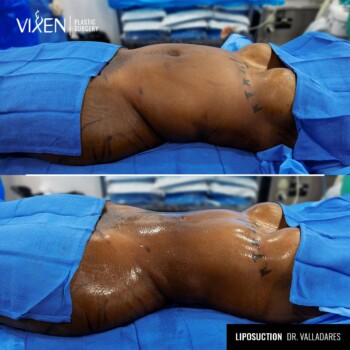 before and after comparison of abdominal liposuction