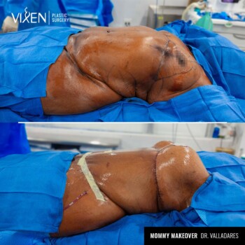 side view of mommy makeover before and after comparison