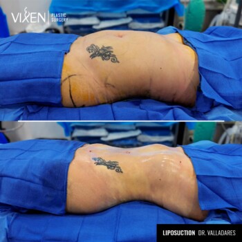 side view before and after comparison of stomach lipo