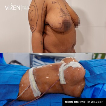 mommy makeover before and after with tummy tuck and breast lift