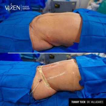 liposuction with tummy tuck before and after