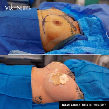 side view before and after comparison of breast augmentation