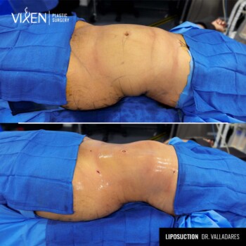 top view before and after comparison of 360 liposuction
