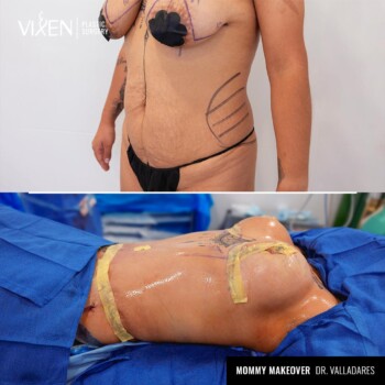 mommy makeover before and after