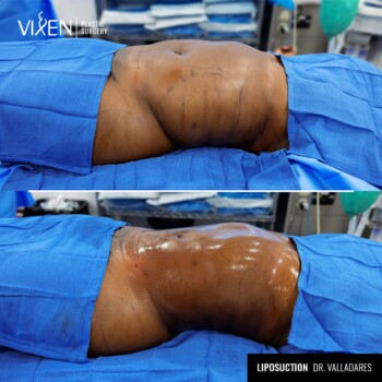 side view before and after comparison of 360 liposuction